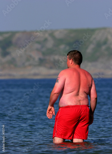 Photo: sunburn alert sunburn alert