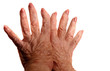 arthritic hands
