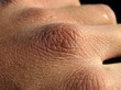 dry skin