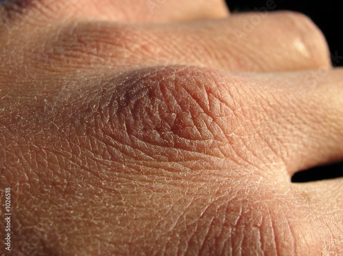 dry skin