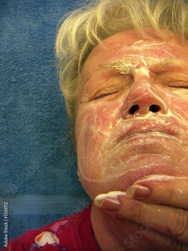 Photo: woman rosacea woman rosacea