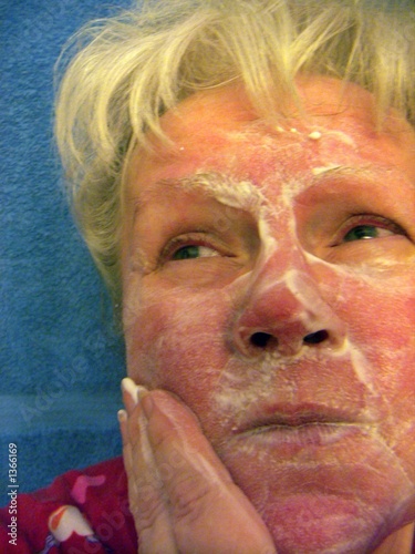 Photo: woman rosacea woman rosacea