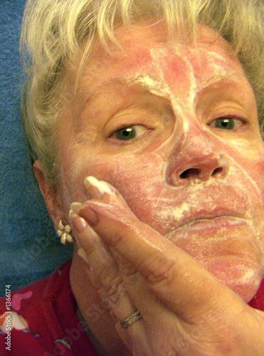 Photo: woman rosacea woman rosacea