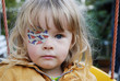 child with eyepatch