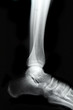 close-up x-ray of a ankle close-up x-ray of a ankle