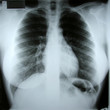 torax xray torax xray