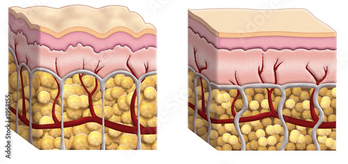 Illustration: cellulite cross section cellulite cross section