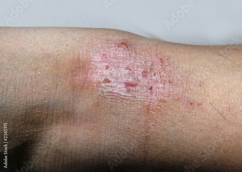 Photo: eczema eczema