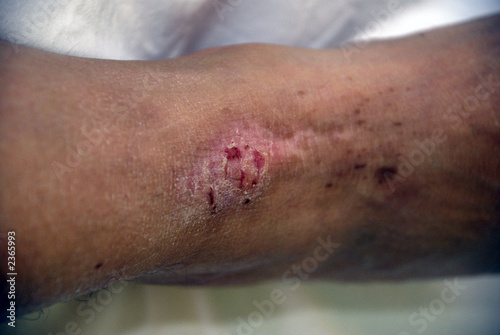 Photo: eczema eczema