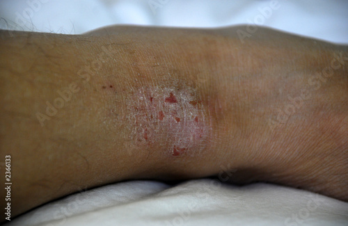 Photo: eczema eczema