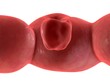 darmtumor
