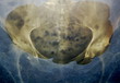hip bones