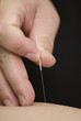 treatment by acupuncture