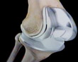 knee replacements