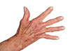 arthritis hand