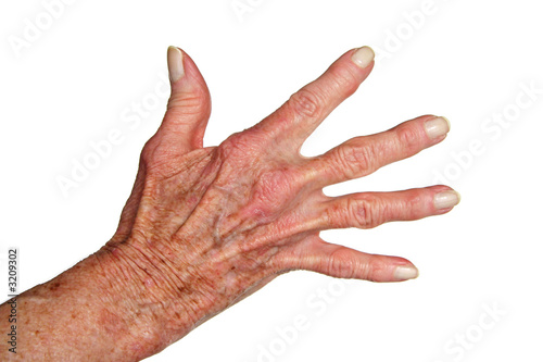 Photo: arthritis hand arthritis hand