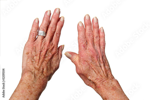 Photo: arthritis hands arthritis hands
