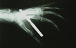 durchbohrte hand