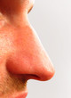 nase