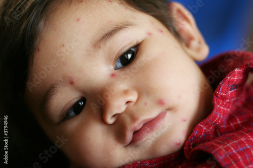 Photo: Baby with Chicken Pox Baby with Chicken Pox