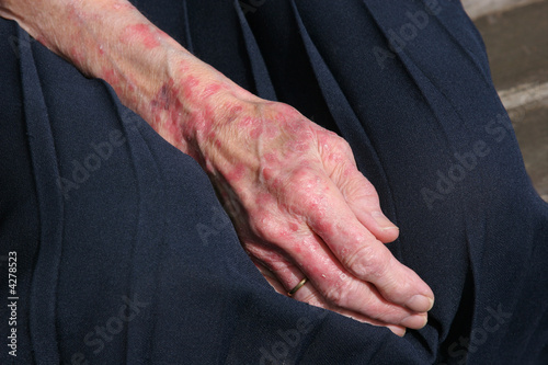 Photo: Sceriosis Skin Condition Sceriosis Skin Condition