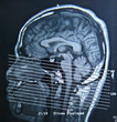 MRI Scan
