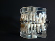 Dentalgebiss mit Stahl-Bracket