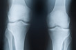 X-ray photograph of knees