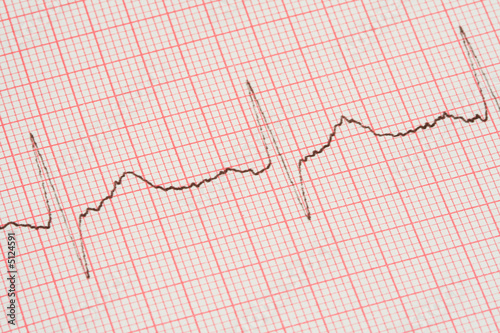 Photo: ECG printout ECG printout