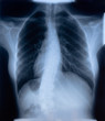 Interesting X-RAY film of female chest