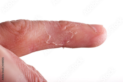 Photo: closeup of eczema on male finger with skin peeling closeup of eczema on male finger with skin peeling