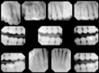 dental x-rays, full set - normal adult, 1 filling dental x-rays, full set - normal adult, 1 filling
