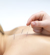 Acupuncture needles on back of a young woman