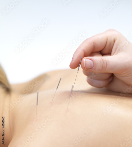 Photo: Acupuncture needles on back of a young woman Acupuncture needles on back of a young woman
