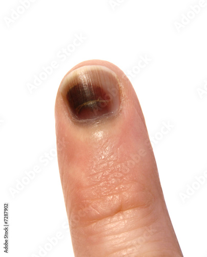 Photo: bruise bruise