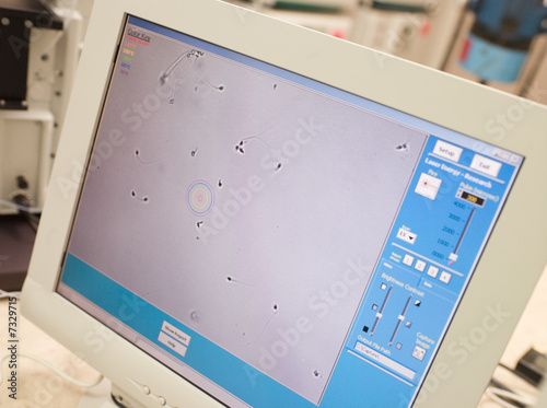 Photo: Monitor showing intra cytoplasmic sperm injection Monitor showing intra cytoplasmic sperm injection
