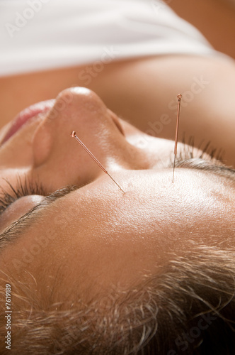 Acupuncture