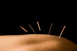 Acupuncture