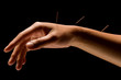 Acupuncture Acupuncture