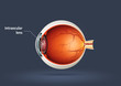 Intraocular lens Intraocular lens