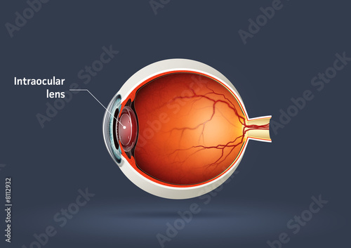 Intraocular lens