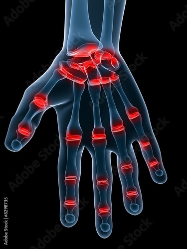 Illustration: gelenkschmerzen der hand gelenkschmerzen der hand