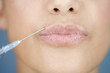 A young woman having a collagen injection