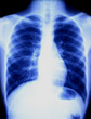 Chest X-ray