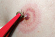 tick on skin
