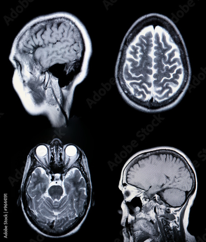 Photo: High Resolution MRI/ MRA (Magnetic Resonance High Resolution MRI/ MRA (Magnetic Resonance