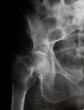 cervical hip (femoral neck) fracture. 100% confirmed diagnosis