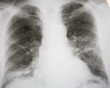 Septic double-sided pneumonia. 100% confirmed diagnosis