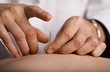 Photo: Tapping in acupuncture needle Tapping in acupuncture needle