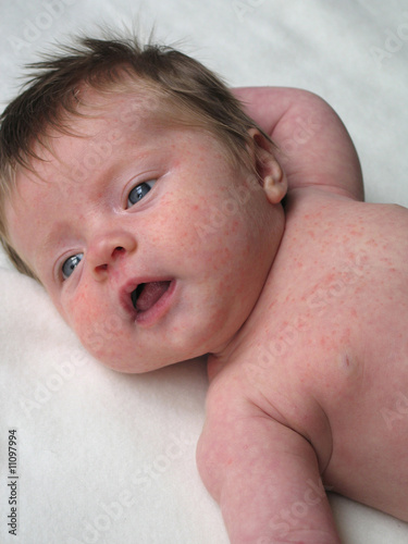 Photo: young baby with a rash young baby with a rash